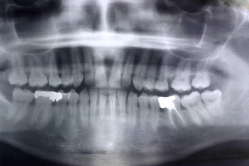 Dental X-rays at North York Dentist accepting new patients.